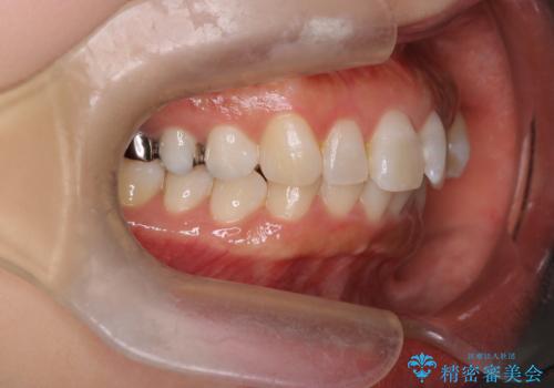 【審美装置】上下の前歯をきれいにしたい の治療前