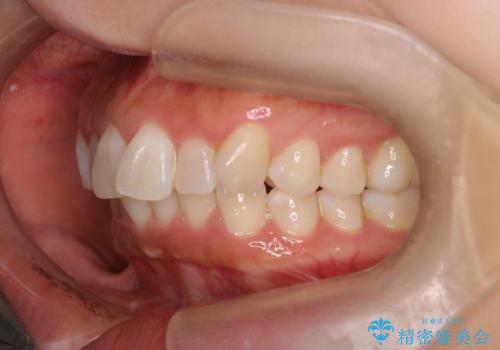 【審美装置】上下の前歯をきれいにしたい の治療前