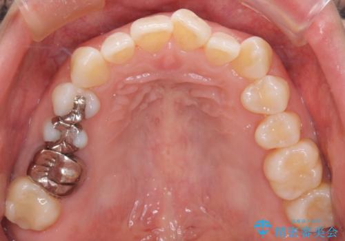 【審美装置】上下の前歯をきれいにしたい の治療前