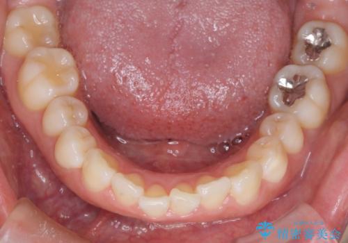 【審美装置】上下の前歯をきれいにしたい の治療前