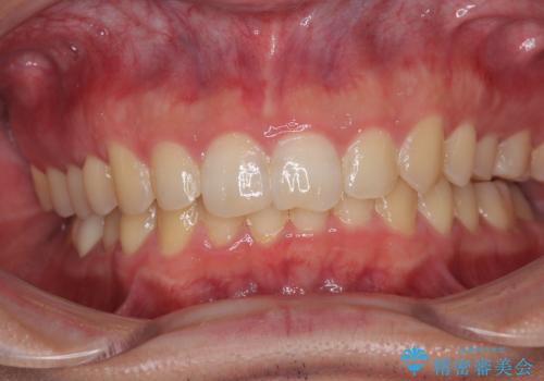 ねじれの強い前歯と奥歯　インビザラインでの矯正治療