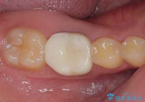 銀歯を白くしたい　オールセラミッククラウンの治療後