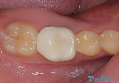 銀歯を白くしたい オールセラミッククラウンの治療後