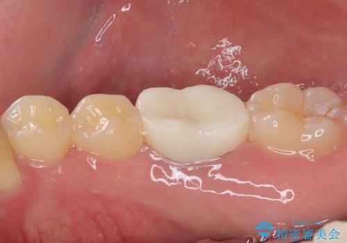 銀歯を白くしたい オールセラミッククラウンの治療後