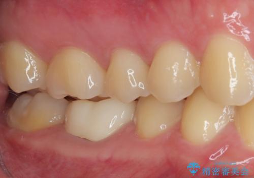 銀歯を白くしたい オールセラミッククラウンの症例 治療後