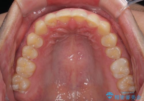 ねじれの強い前歯と奥歯　インビザラインでの矯正治療の治療後