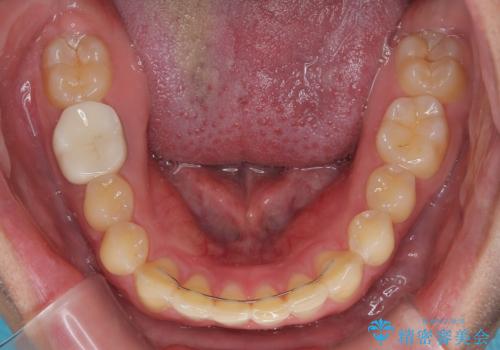 ねじれの強い前歯と奥歯　インビザラインでの矯正治療の治療後