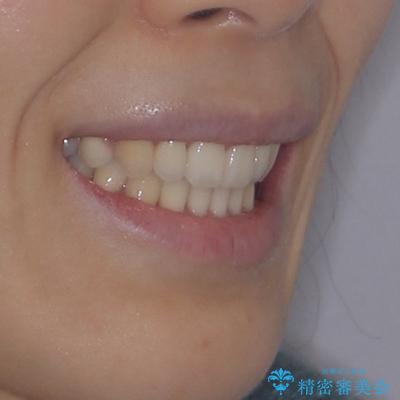 閉じにくい口元をワイヤー抜歯矯正でスッキリした口元にの治療後(顔貌)