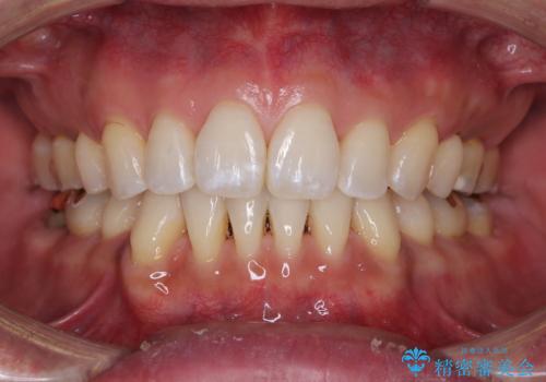 【モニター】口が閉じにくい 抜歯矯正でスッキリした口元にの症例 治療後