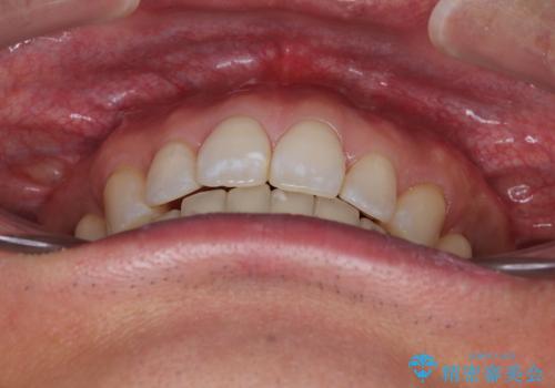 【モニター】口が閉じにくい 抜歯矯正でスッキリした口元にの治療後