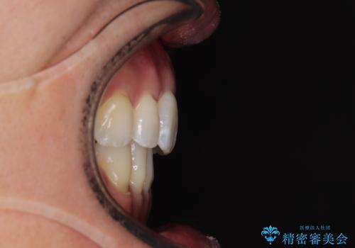 【モニター】口が閉じにくい 抜歯矯正でスッキリした口元にの治療後