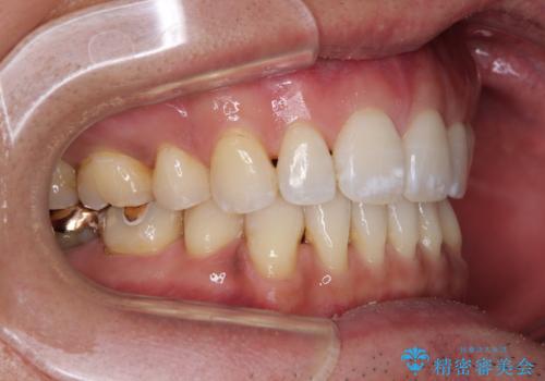 【モニター】口が閉じにくい 抜歯矯正でスッキリした口元にの治療後