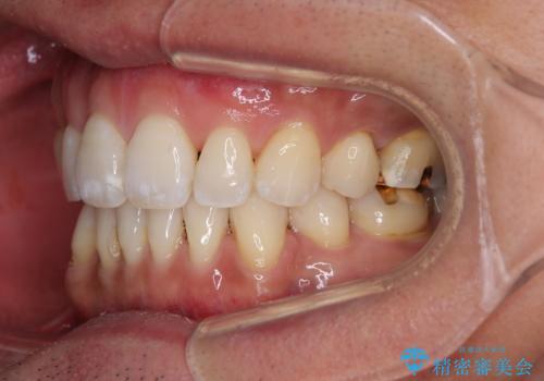 【モニター】口が閉じにくい 抜歯矯正でスッキリした口元にの治療後