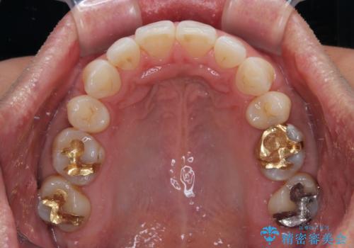 【モニター】口が閉じにくい 抜歯矯正でスッキリした口元にの治療後