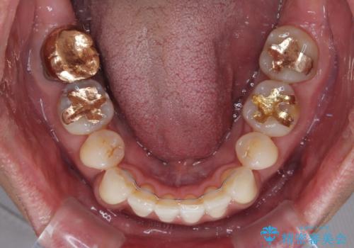 【モニター】口が閉じにくい 抜歯矯正でスッキリした口元にの治療後