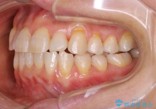 前歯の反対咬合、奥に引っ込んでしまっている歯をインビザラインで治療するの治療中