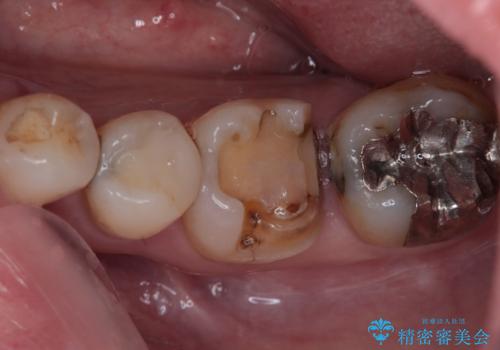 金属の詰め物が取れた オールセラミッククラウンの治療前