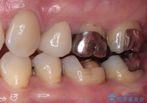 金属の詰め物が取れた オールセラミッククラウンの治療前