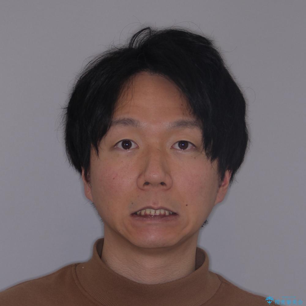 【モニター】八重歯と正中のずれた歯列 片顎抜歯のワイヤー矯正の治療後(顔貌)