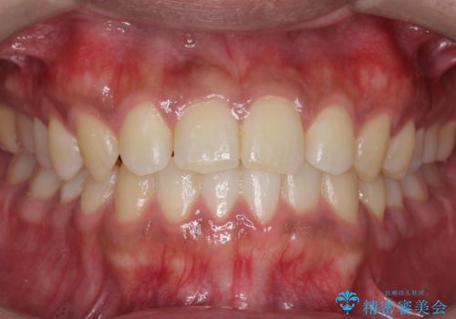 骨格性の受け口の矯正　部分ワイヤーで上の前歯を前に、　マウスピースで下の前歯を後ろに。の症例 治療後