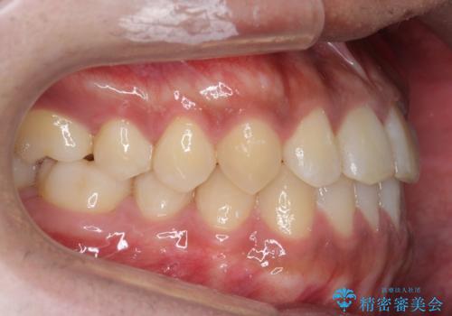 骨格性の受け口の矯正 部分ワイヤーで上の前歯を前に、 マウスピースで下の前歯を後ろに。の治療後