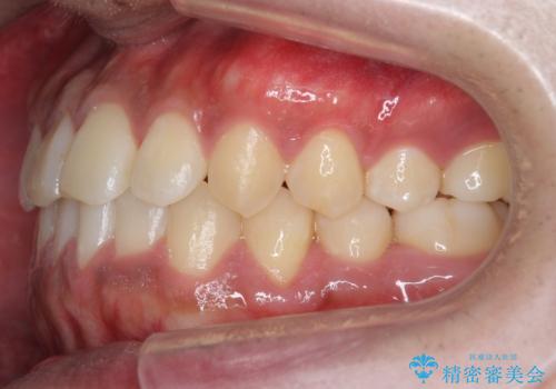 骨格性の受け口の矯正 部分ワイヤーで上の前歯を前に、 マウスピースで下の前歯を後ろに。の治療後