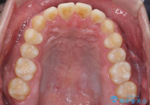 骨格性の受け口の矯正 部分ワイヤーで上の前歯を前に、 マウスピースで下の前歯を後ろに。の治療後