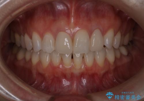 前歯治したい『根管治療 セラミック治療』の症例 治療後