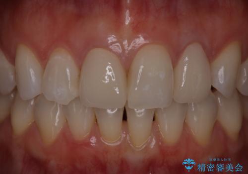 前歯治したい『根管治療 セラミック治療』の治療後