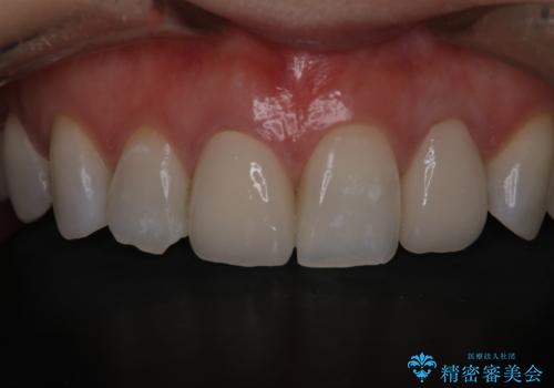 前歯治したい『根管治療 セラミック治療』の治療後