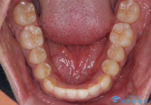 骨格性の受け口の矯正 部分ワイヤーで上の前歯を前に、 マウスピースで下の前歯を後ろに。の治療後