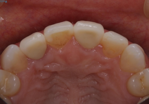 前歯治したい『根管治療　セラミック治療』の治療後