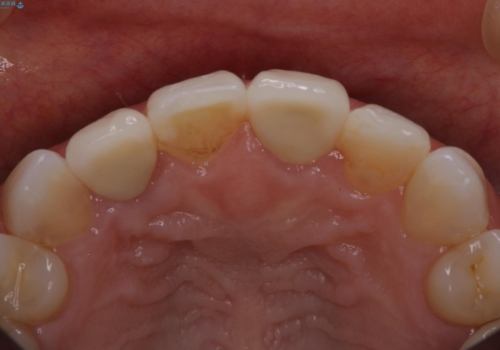 前歯治したい『根管治療 セラミック治療』の治療後