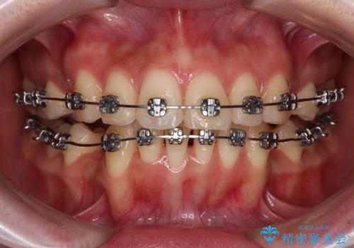 【モニター】飛び出した上顎前歯を抜歯矯正で引っ込める　ワイヤー装置の抜歯矯正治療の治療中
