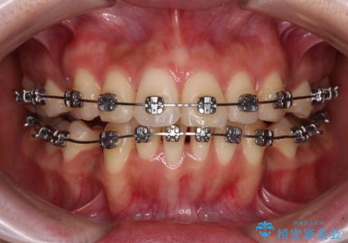 【モニター】飛び出した上顎前歯を抜歯矯正で引っ込める ワイヤー装置の抜歯矯正治療の治療中