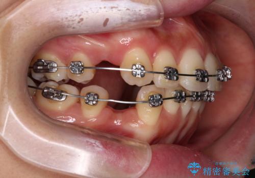 【モニター】飛び出した上顎前歯を抜歯矯正で引っ込める ワイヤー装置の抜歯矯正治療の治療中