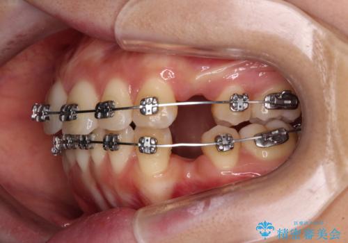 【モニター】飛び出した上顎前歯を抜歯矯正で引っ込める ワイヤー装置の抜歯矯正治療の治療中