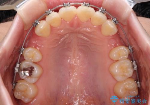 【モニター】飛び出した上顎前歯を抜歯矯正で引っ込める ワイヤー装置の抜歯矯正治療の治療中