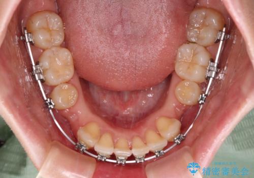 【モニター】飛び出した上顎前歯を抜歯矯正で引っ込める ワイヤー装置の抜歯矯正治療の治療中