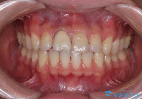 前歯のセラミックをやり替えたいの症例 治療前