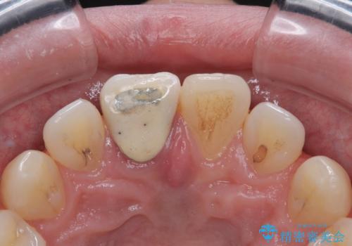 前歯のセラミックをやり替えたいの治療前