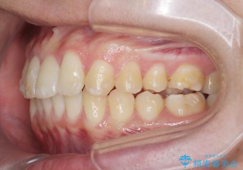 [ インビザライン ]  目立つすきっ歯をマウスピース矯正で改善の治療中