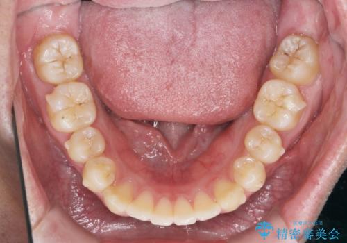 [ インビザライン ]  目立つすきっ歯をマウスピース矯正で改善の治療中