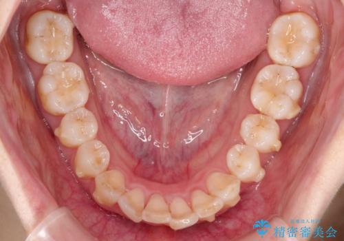 透明なマウスピースで前歯のガタツキを改善の治療中