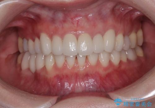 気にしていた歯並びをインビザラインで改善 セラミックも作り替えて綺麗な口元にの治療後