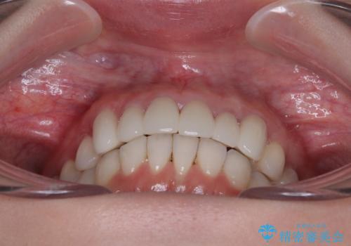 気にしていた歯並びをインビザラインで改善 セラミックも作り替えて綺麗な口元にの治療後