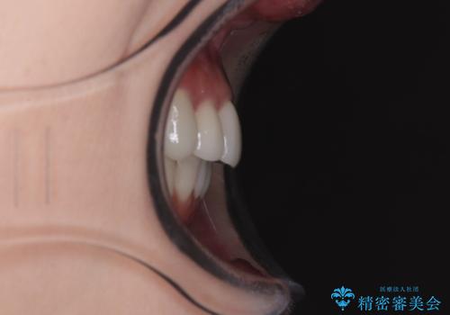 気にしていた歯並びをインビザラインで改善 セラミックも作り替えて綺麗な口元にの治療後