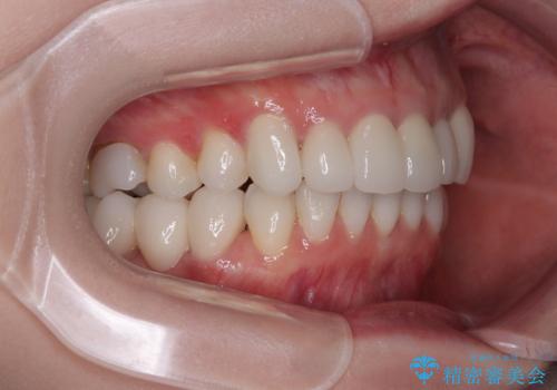 気にしていた歯並びをインビザラインで改善 セラミックも作り替えて綺麗な口元にの治療後