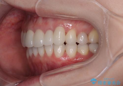 気にしていた歯並びをインビザラインで改善 セラミックも作り替えて綺麗な口元にの治療後