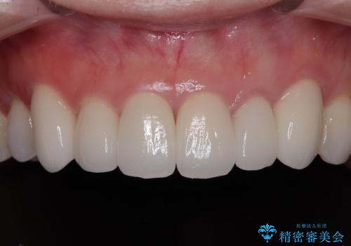 気にしていた歯並びをインビザラインで改善 セラミックも作り替えて綺麗な口元にの治療後
